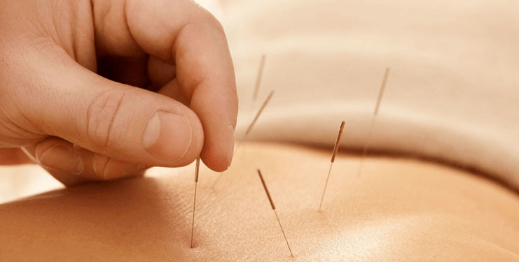 Acupuncture to quit smoking